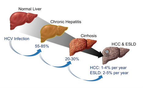 Hepatitis C and Liver Cancer What toKnow